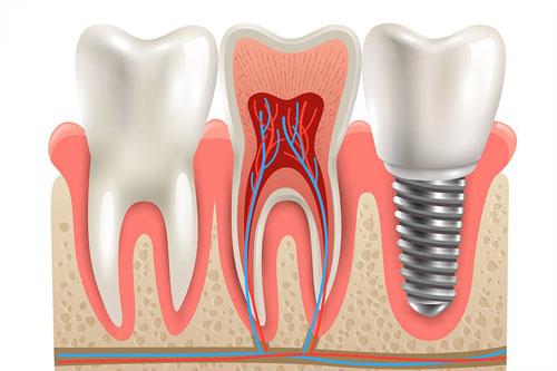 ایمپلنت دندان 2