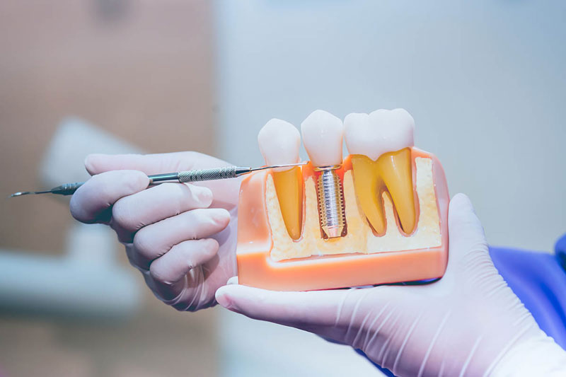 پیوند دندان یک روش دندانپزشکی